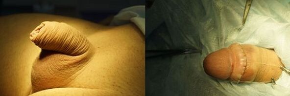 пенис пре и после операције повећања