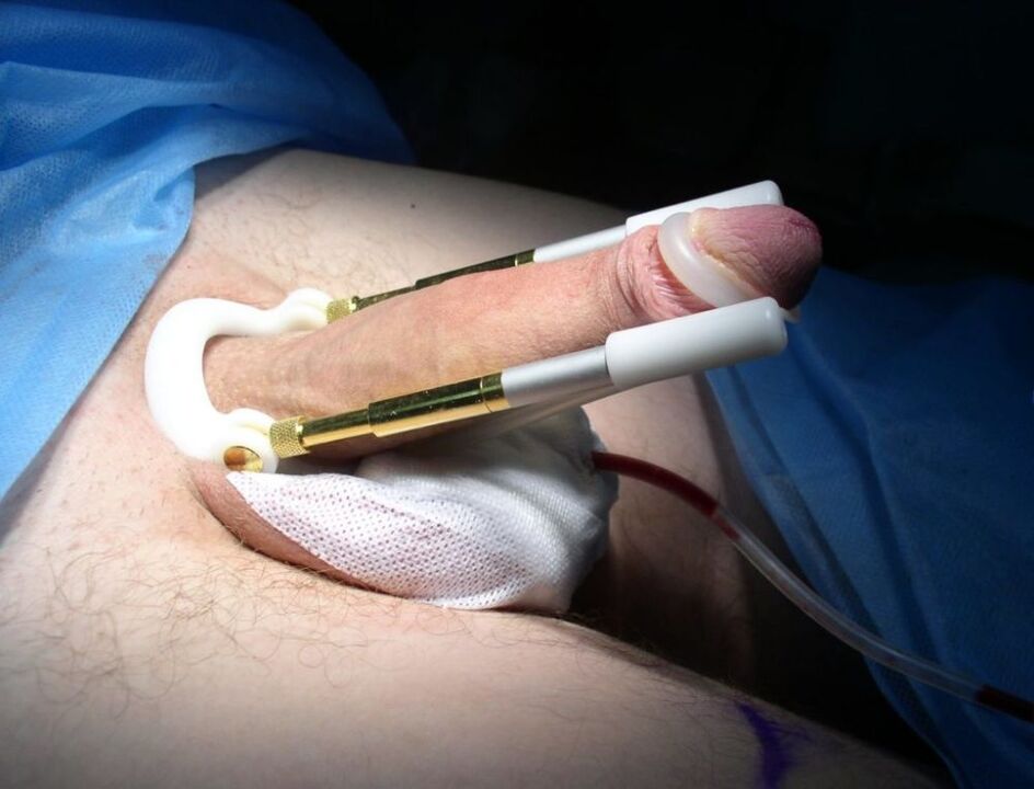 продуживач након операције повећања пениса
