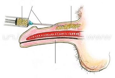 ињекција за повећање пениса